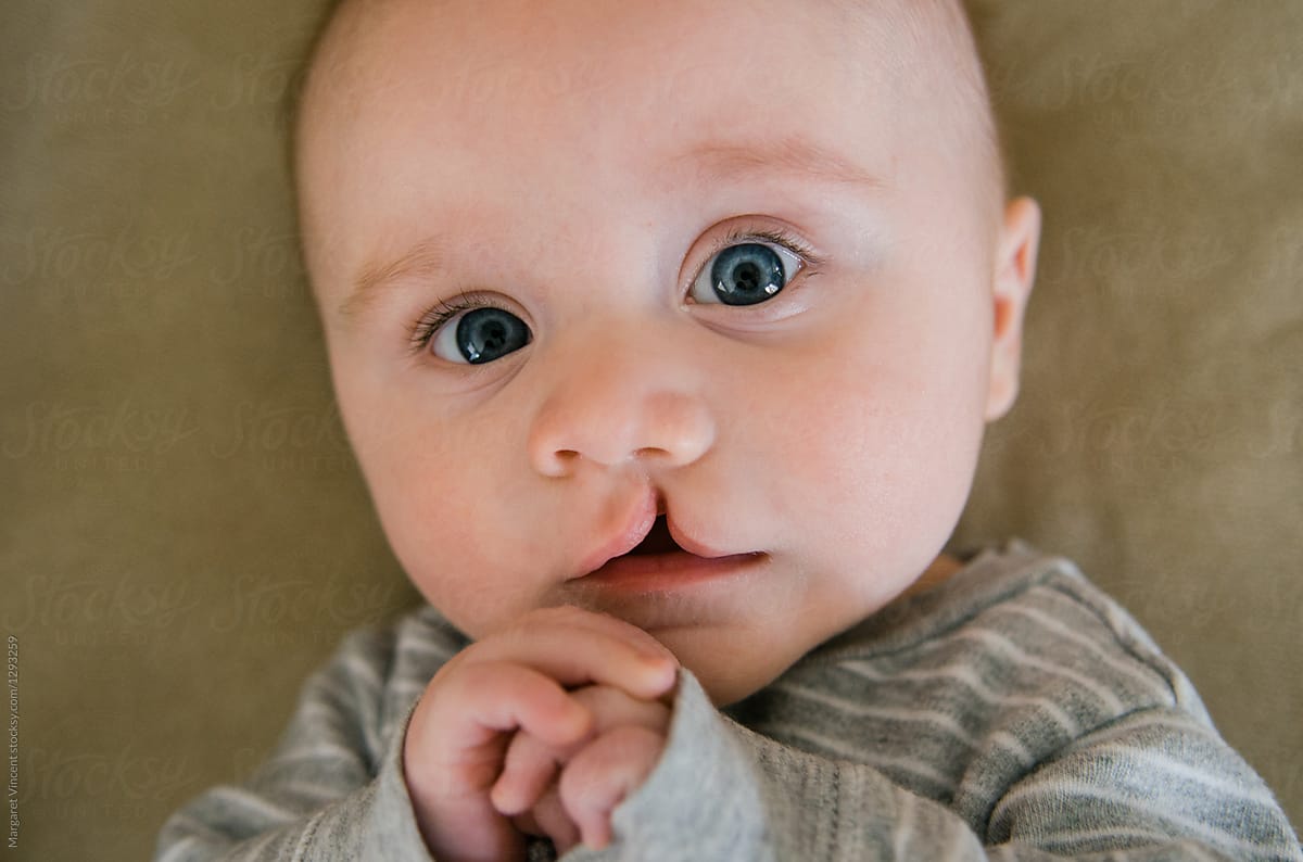 All about Cleft Lip and Palate: What You Should Expect and ...