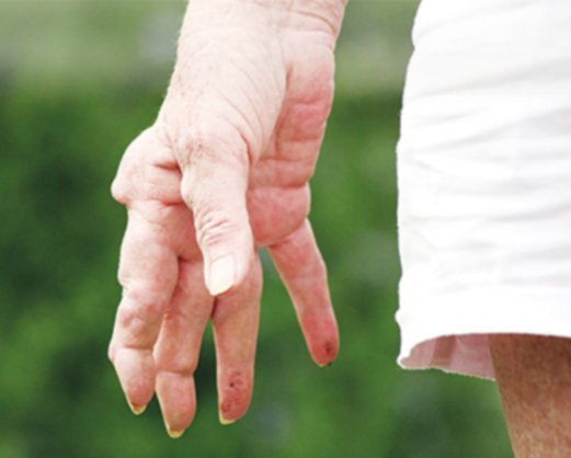 Blow this joint: On treating and living with rheumatoid arthritis