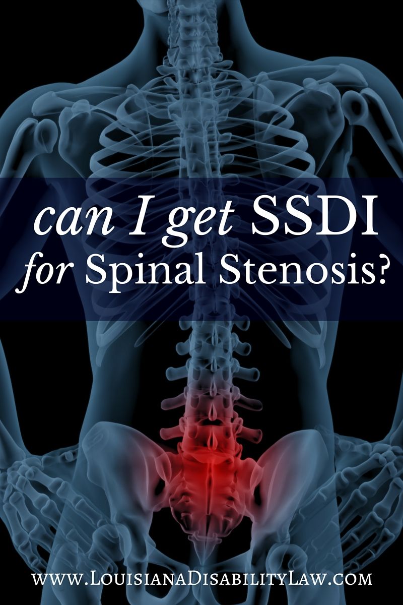 Can I get Social Security Disability for Spinal Stenosis ...