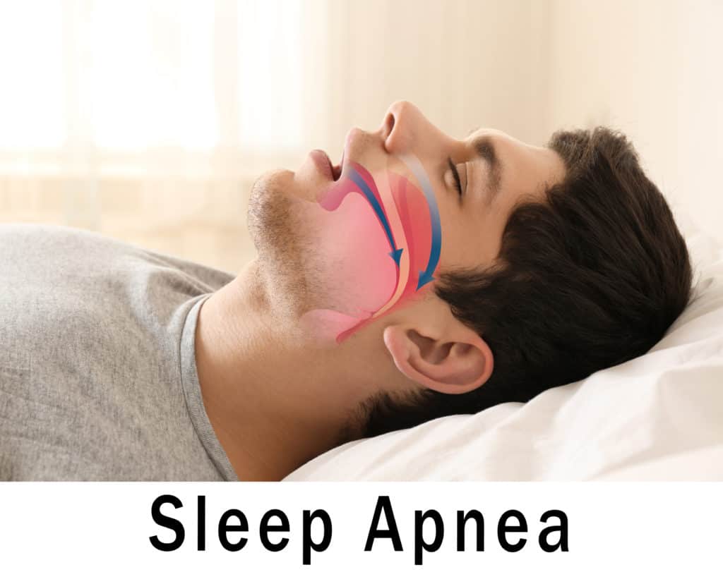 Can Ptsd Cause Sleep Apnea