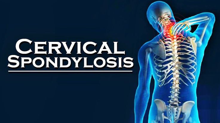 Cervical spondylosis is a general term for age