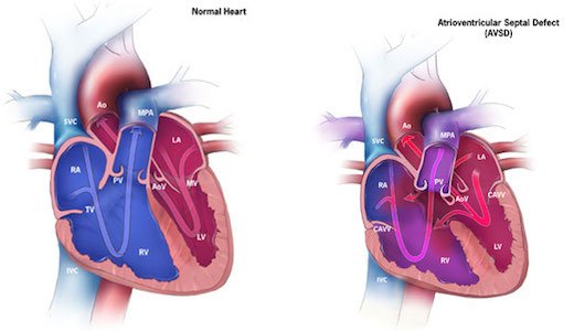 Clues to genetics of congenital heart defects emerge from ...