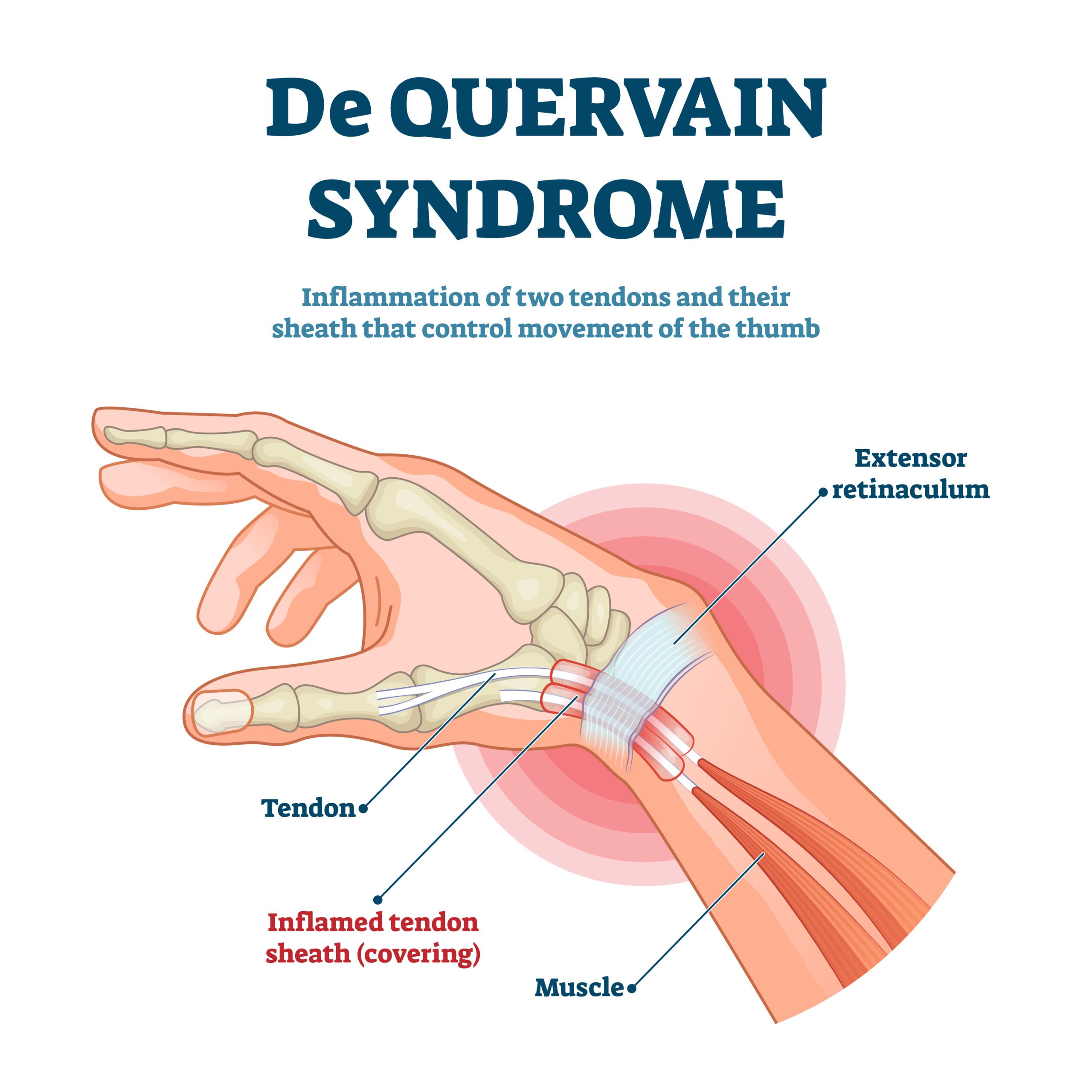 De Quervains Disease: A Closer Look