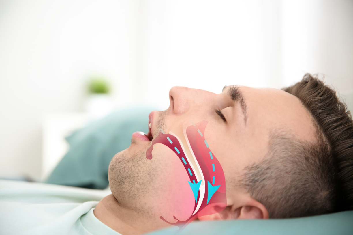 Diagnosing &  Treating Obstructive Sleep Apnea
