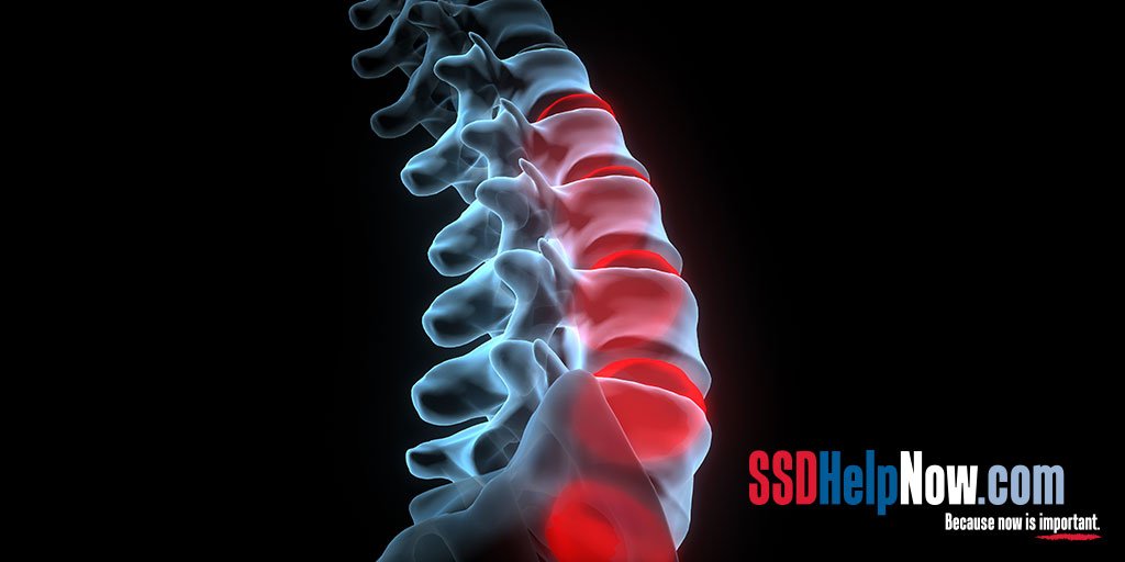 Disability for Scoliosis