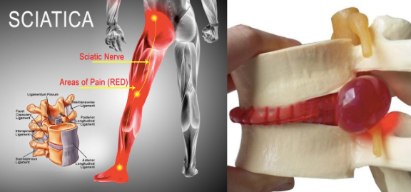 Disc Herniation and Sciatica Explained with a Quick Test ...