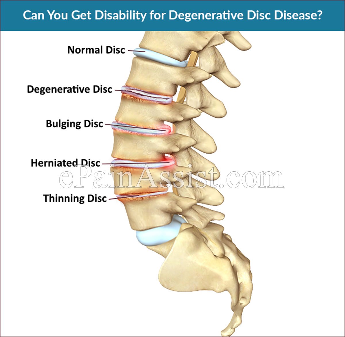 Does Degenerative Disc Disease Qualify For Disability ...