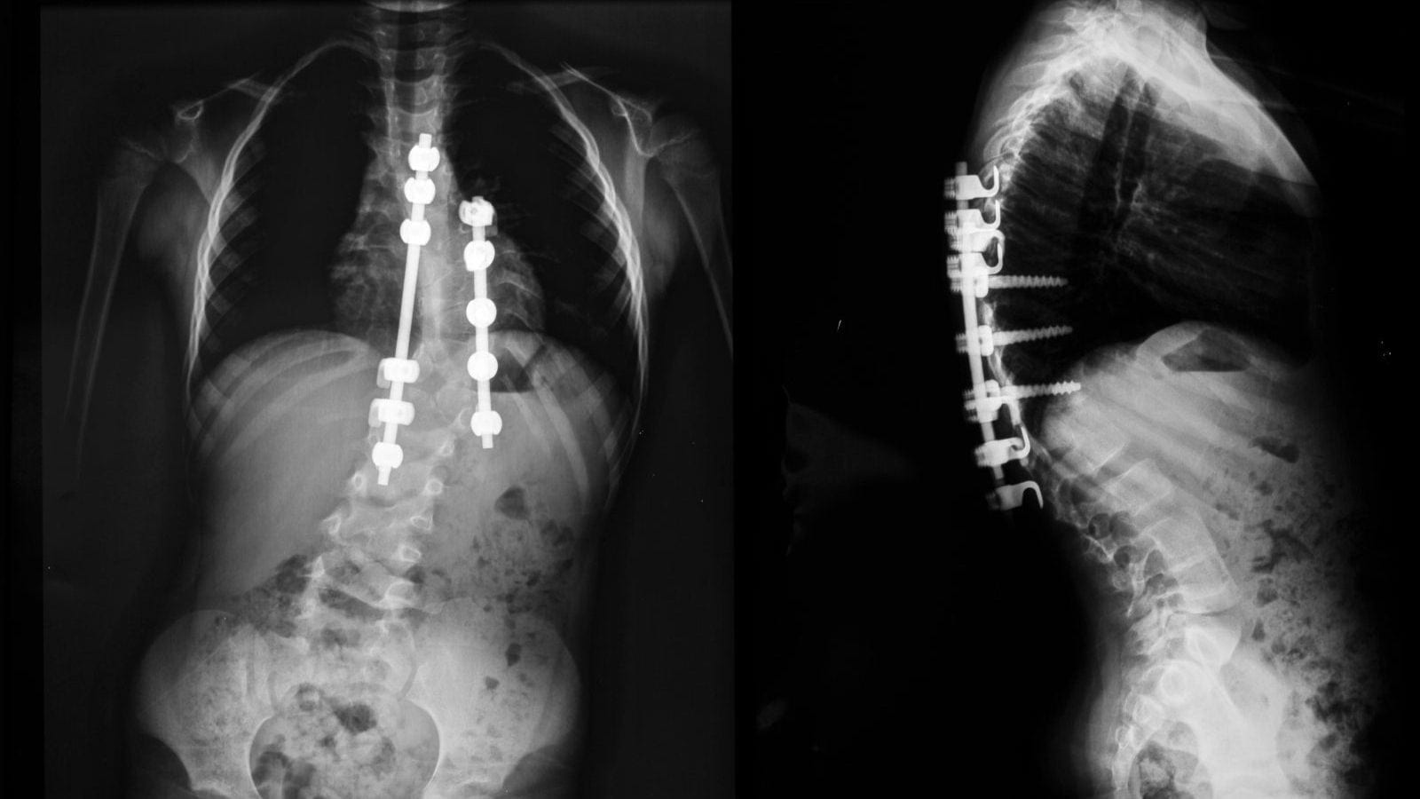 Does Scoliosis Qualify For Social Security Disability?