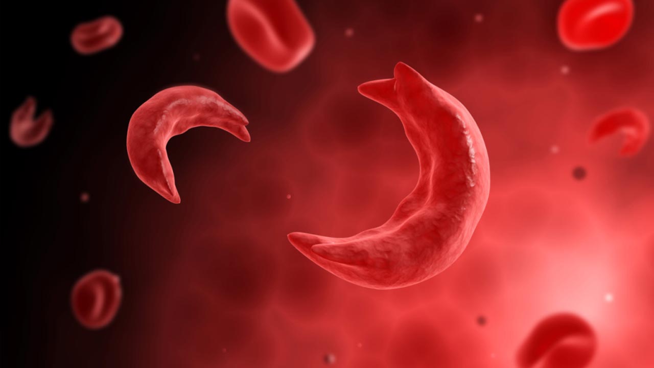 First sickle cell patient cured with gene therapy  News ...