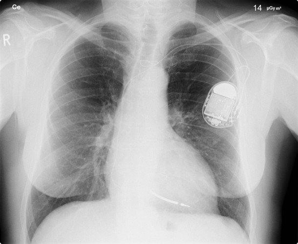 Heart Patients Using Pacemakers Can Now Take MRI Tests ...