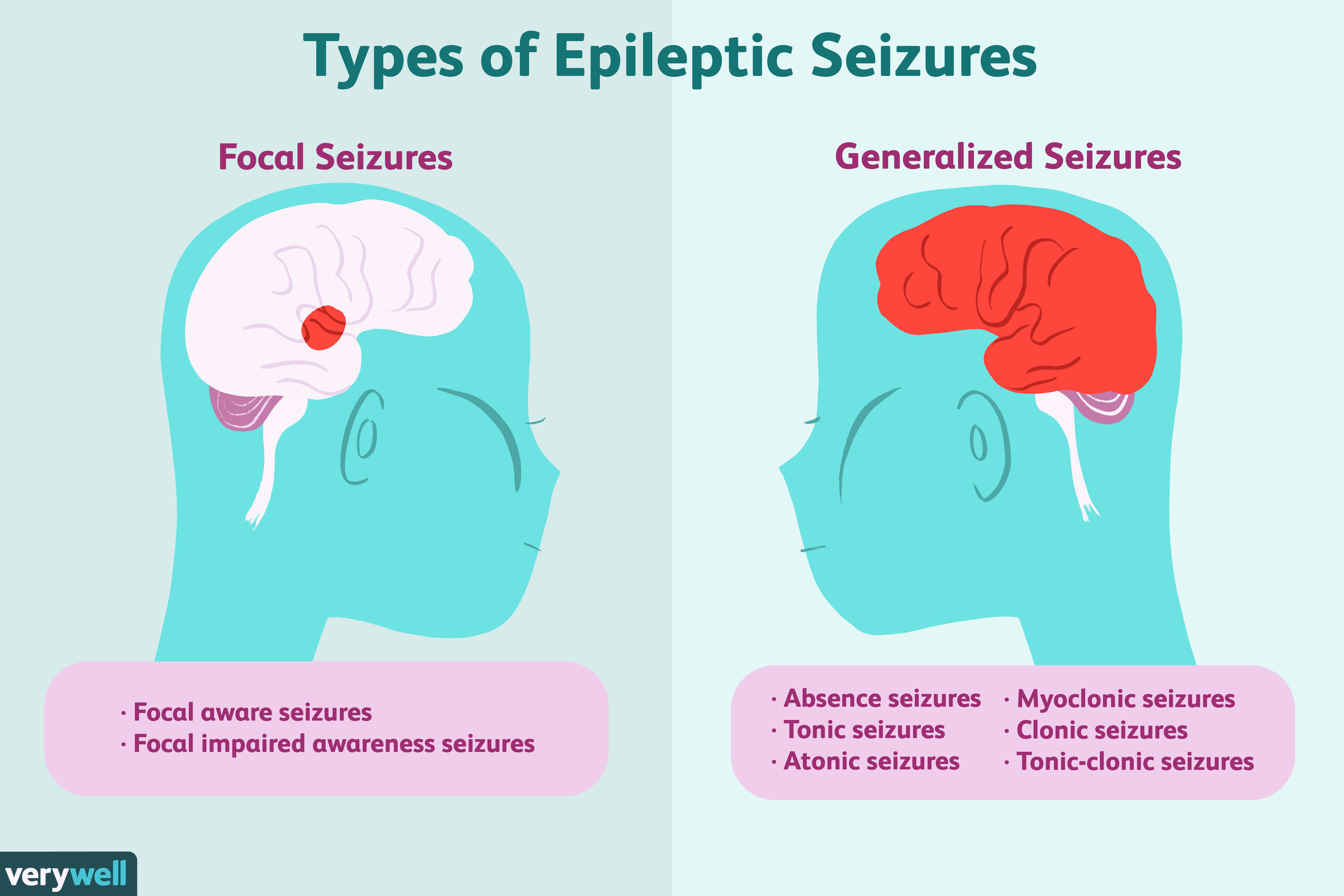 How Epilepsy Is Treated