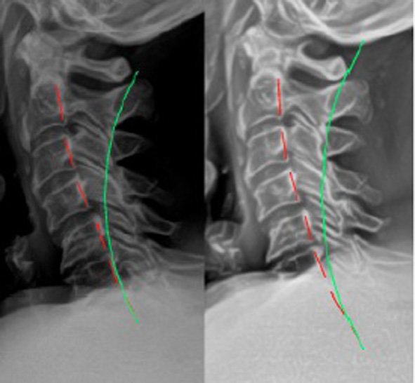 Lateral cervical radiographs. Left: Initial (Oct. 16, 2018 ...
