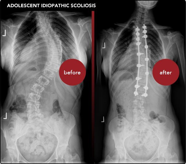 Pediatric Scoliosis: Early Detection is Key