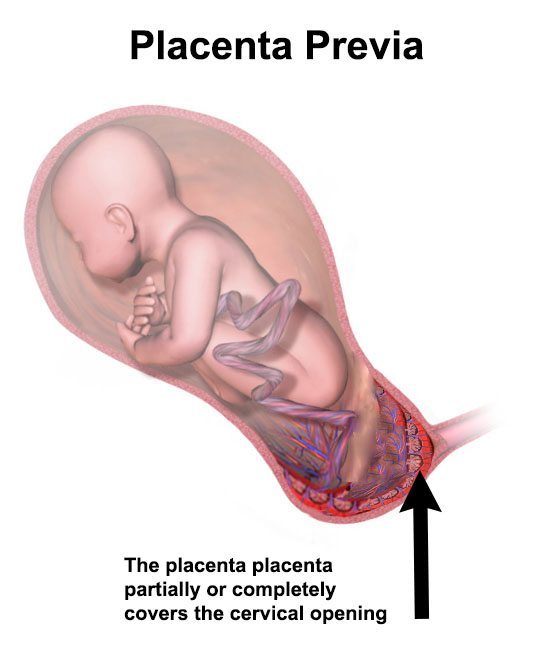 Placenta Previa, Birth Injury and Hypoxic