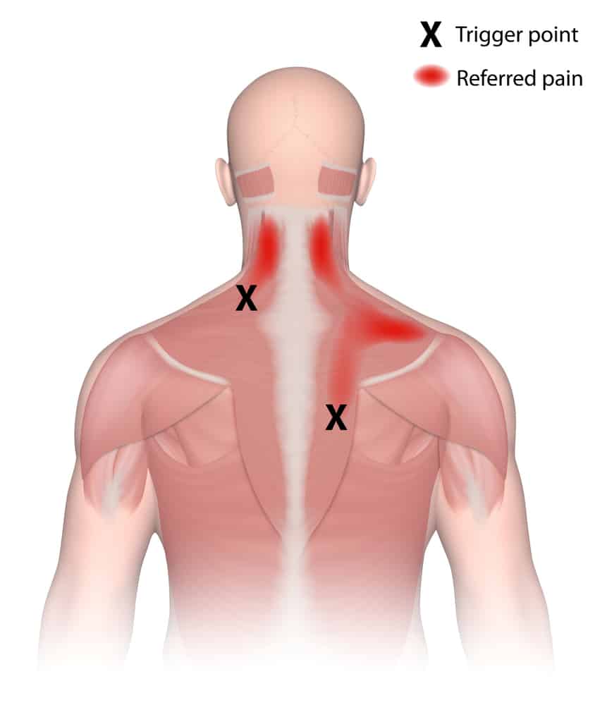 Trigger Point Injections in Sinking Spring &  Reading, PA