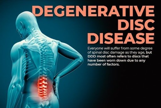 Va Disability For Degenerative Joint Disease