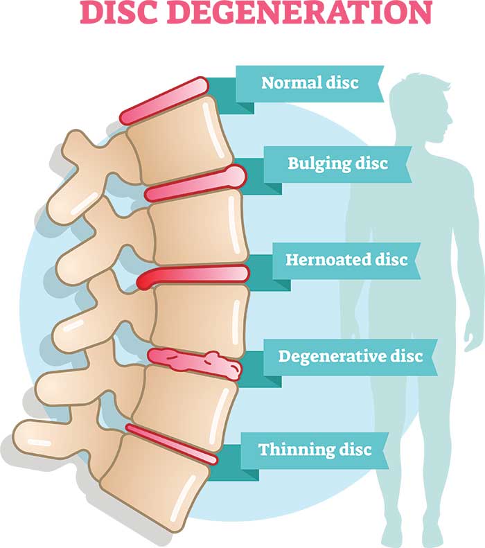What To Look For In A Mattress With Degenerative Disc Disease
