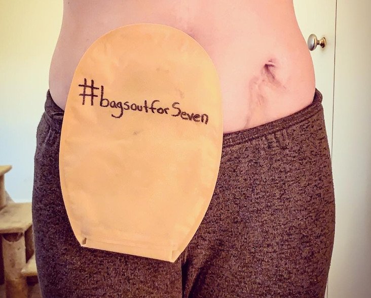 Why Thousands of People Are Sharing Their Ostomy Bags on ...
